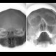 Fibrous dysplasia of frontal bone: X-ray - Plain radiograph